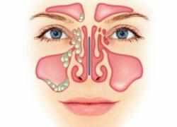полипоза носа