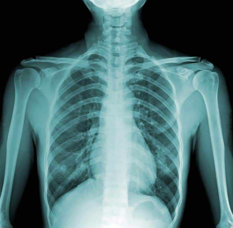 Что показывает рентген грудной клетки