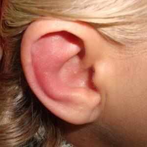 гиперемия слухового прохода что это такое