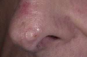 базалиома носа лечение