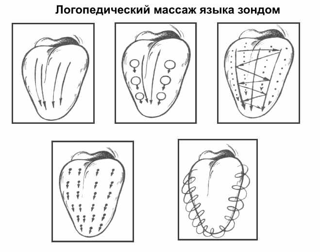 Схема логопедического массажа языка зондом