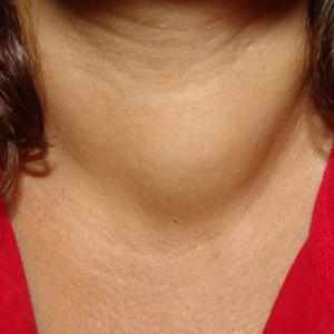 Симптомы увеличения щитовидки