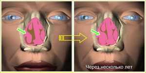 Гипертрофия носовых раковин