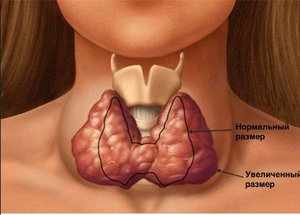 Как проявляется увеличение щитовидной железы