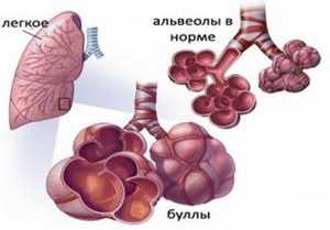 Состояние больных альвеол при буллезной болезни легких