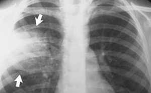 На рентгеновском снимке пневмония