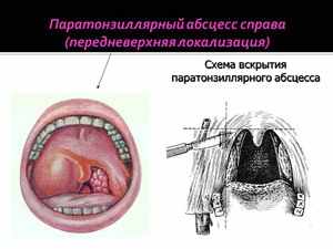 Лечение абсцесса в горле