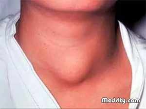 Стадии увеличения щитовидки