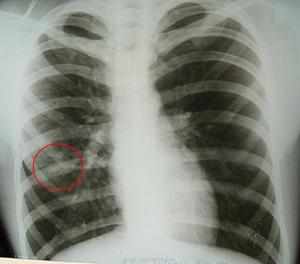 Рентгенография легких - как определить болезни на снимке
